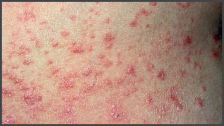Pictures of psoriasis rash