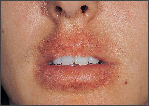 pictures psoriasis around mouth