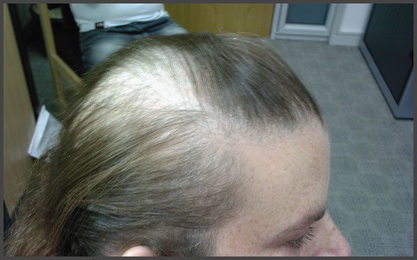 psoriasis and hair loss pictures
