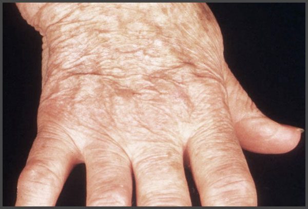 Psoriasis arthritis pictures