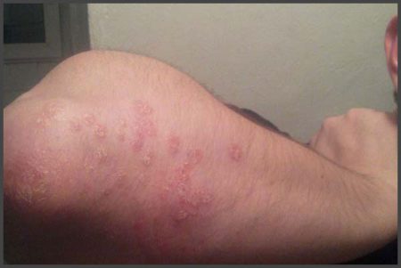 psoriasis elbow pictures