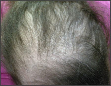 psoriasis hair loss pictures