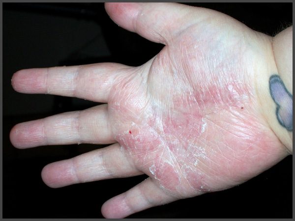 psoriasis hands feet pictures
