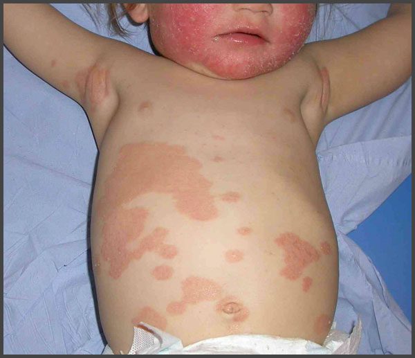 psoriasis infants pictures