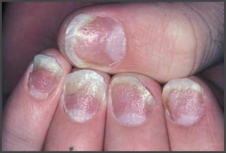 psoriasis nail pitting pictures