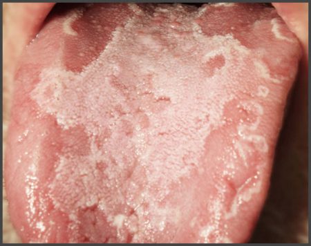 Psoriasis of the tongue pictures