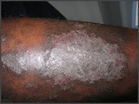 psoriasis on african american skin pictures