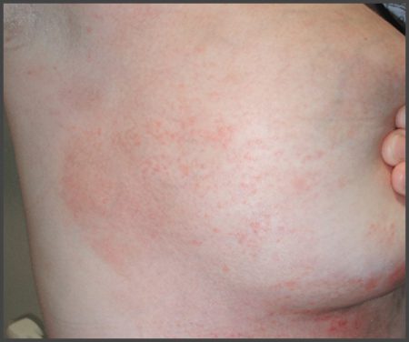 psoriasis on areola pictures