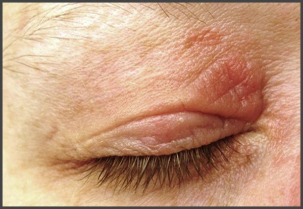 psoriasis on eyelids pictures