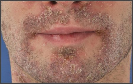 psoriasis on face pictures