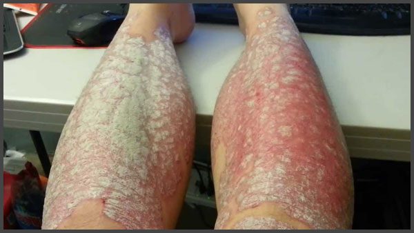 psoriasis on lower legs pictures