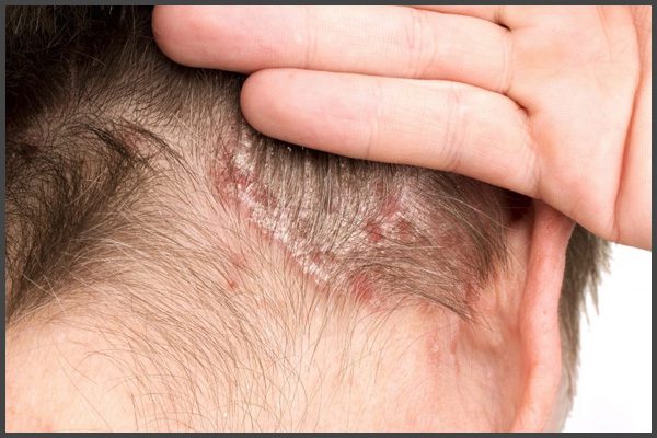 psoriasis on neck pictures