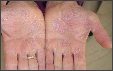 Psoriasis on palms pictures