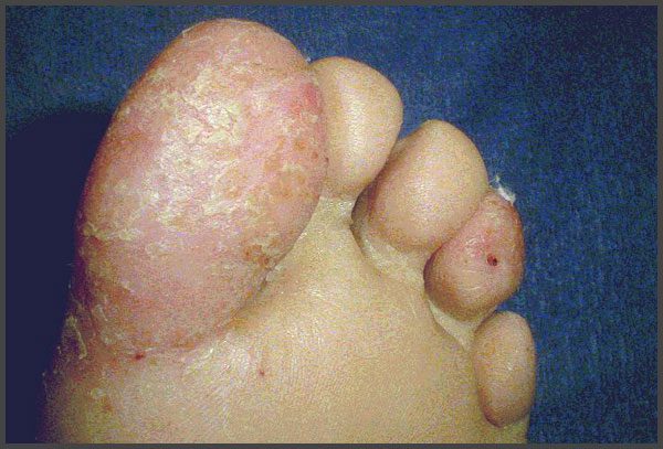 Psoriasis on toes pictures