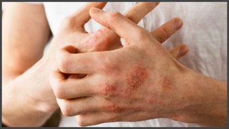 psoriasis or eczema pictures