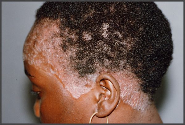 psoriasis pictures african american skin