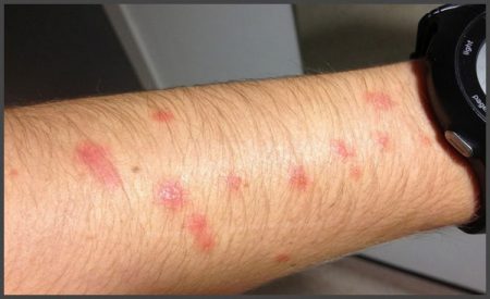 Psoriasis pictures on arms