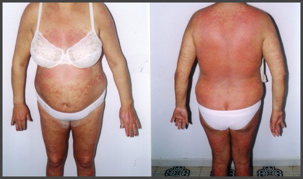 psoriasis pictures on body