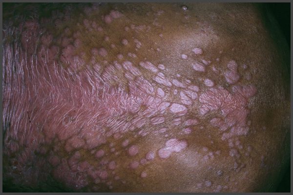 psoriasis pictures on dark skin