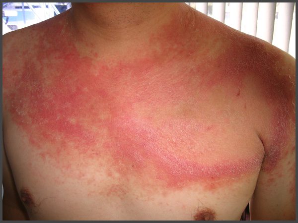psoriasis skin disease pictures