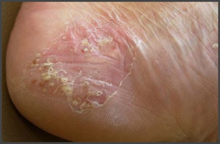 pustular psoriasis on feet pictures