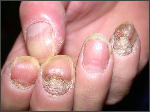 severe nail psoriasis pictures