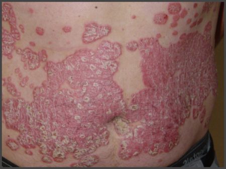 skin condition psoriasis pictures