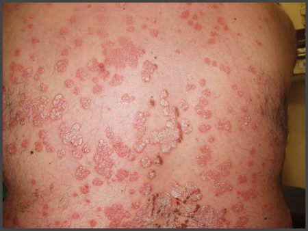 skin psoriasis pictures