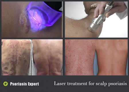 Laser treatment for psoriasis