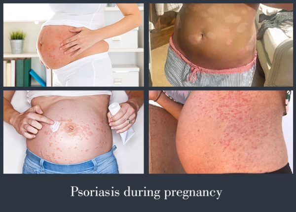 guttate psoriasis pregnancy vörös foltok az arcon és nyomás