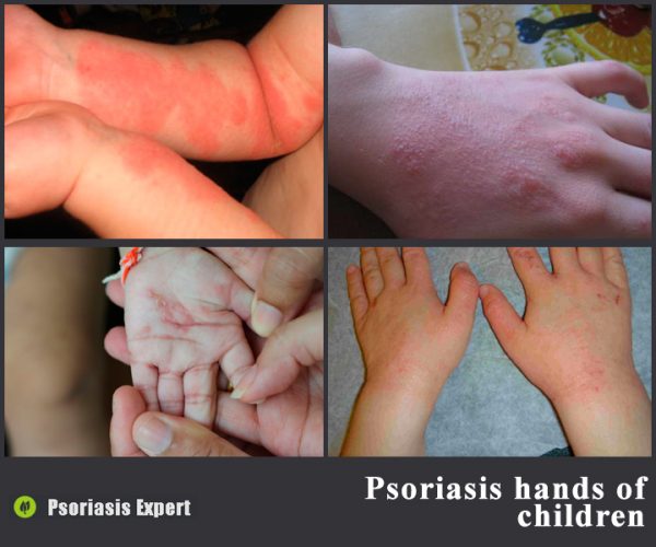 Psoriasis on the hands of children