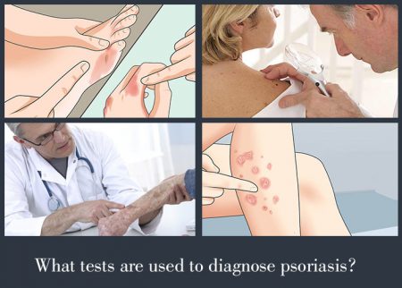 What tests are used to diagnose psoriasis