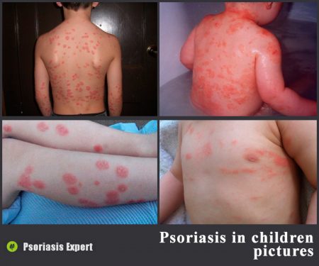 pictures of psoriasis in children
