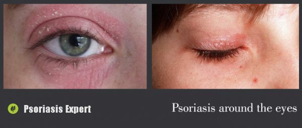 psoriasis around the eyes