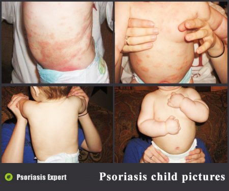 psoriasis child pictures