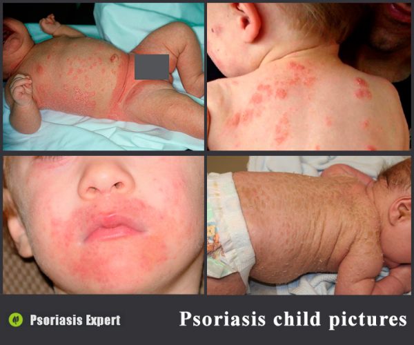 psoriasis in children pictures