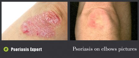 psoriasis on elbows pictures