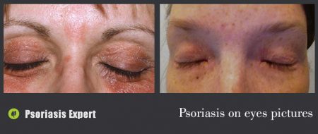 psoriasis on eyes pictures
