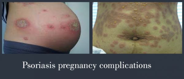 psoriasis pregnancy complications