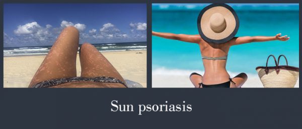 sun psoriasis
