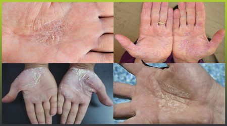 Psoriasis hands and palms