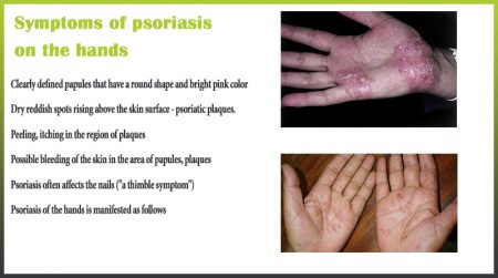 Symptoms psoriasis hands