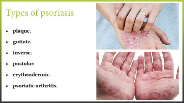 Types of psoriasis