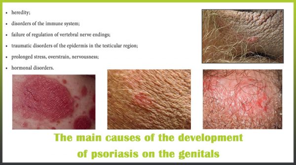 causes psoriasis genitals